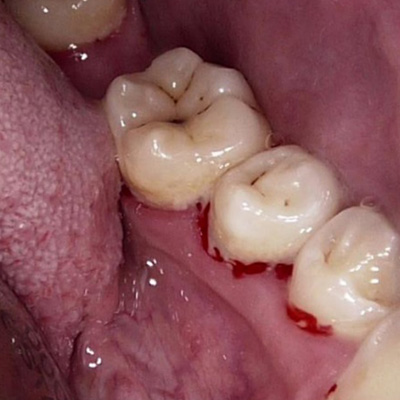 zubni hygiena zanet dasni 2