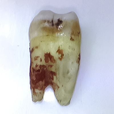 zubni hygiena zubni kamen 3